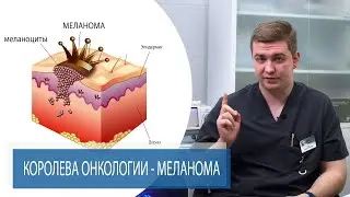 МЕЛАНОМА |  Королева онкологии | рак кожи