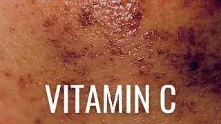 HOW Vitamin C PREVENTS Hyperpigmentation