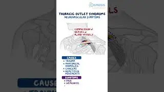 Thoracic Outlet Syndrome