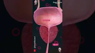 Benign Prostatic Hyperplasia ❗