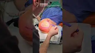 Personalized 3D printed cranial implants