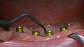 Cleaning & Maintaining Zest LOCATOR Overdentures Techniques