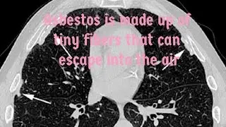Asbestos related lung disease