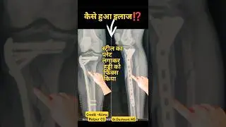 Leg Bone Fracture Treatment 🔥 टांग की हड्डी टूट गई ⁉️ 