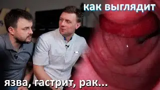 Как реально выглядит рак, эрозия, язва и другие заболевания ЖКТ. Разбор снимков с гастроскопии