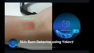 Official YOLOv7 |  Skin Burn Detector with OpenCV using Python
