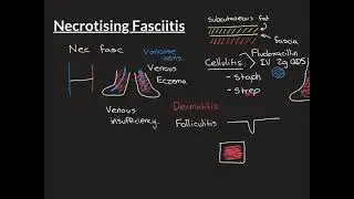 Necrotising Fasciitis