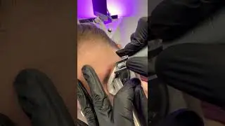 Удаление татуажа бровей в клинике Sokolov Laser 