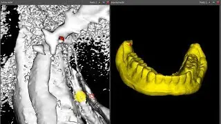 In-Office 3D Printed LODI Surgical Guide Technique with Blue Sky Plan & Radiopaque PVS