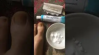 Как вылечить грибок на ногте с помощью соды и вазелина