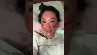 Get salmon sperm injections with me🐟 #salmonsperm #facial #skinpeicedure