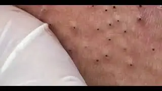 #28 Popping Tons Of Blackheads Part 01