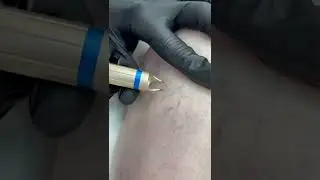 Лазерное удаление купероза (сосудистой сетки) в Sokolov Laser