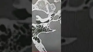 Стеноз наружного слухового прохода на КТ.