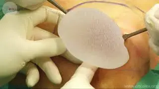 Breast reconstruction with a silicone implant