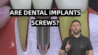 Why Dental Implants are NOT Screws!