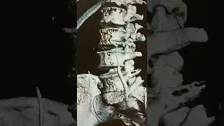 Извитость мочеточника при КТ урографии