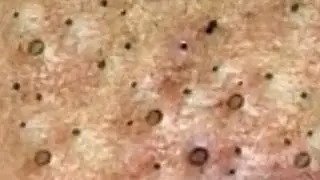 Blackheads & Whiteheads Satisfying Removal @0152