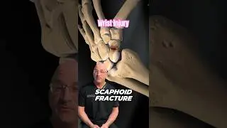 Frequently Misdiagnosed Reason Your Wrist Hurts 