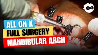 All on X Full Surgery Mandibular Arch