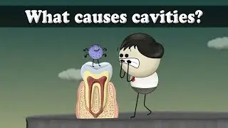 What causes cavities? | 