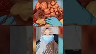 Luka Infeksi Akibat Alergi parfum 😱|Mv 
