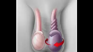 Testicular Torsion