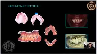 Dora Rodrigues All on 4 Conversion Technique Overview for Immediate