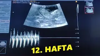 12 Hafta 1 Günlük Hamilelik Ultrason Görüntüsü