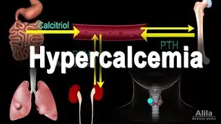 Hypercalcemia - Too Much Calcium, Animation