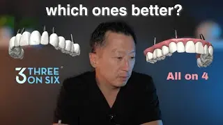 All On 4 VS. 3 On 6 - Dentist Reacts