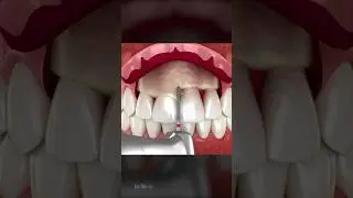 Frontal Crown Lengthening: Dental Procedure