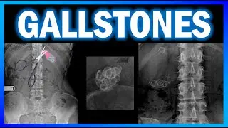 Gallstones #xray #radiology #medical