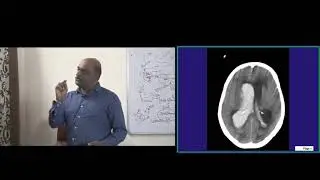 Revise 20000 Bullet Points in 10000 Minutes with Dr Murali Bharadwaz for NEETPG everyday 6pm 65