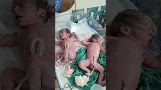 Twins baby after birth 