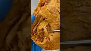 Real Human Heart Valve!