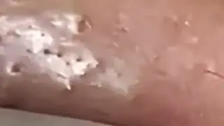 Blackheads & Whiteheads Satisfying Removal @0076