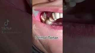 Dental Cleaning, Dental Scaling 
