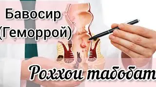 ГЕМОРРОЙ.  Роҳҳои пешгири ва табобат 