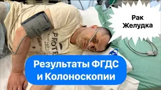 Рак Желудка - в Больнице. Результаты ФГДС и Колоноскопии. Отвечаю на вопросы зрителей в прямом Эфире