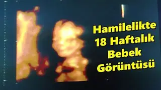 18 Haftalık Gebelik Ultrason Görüntüleri