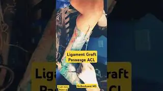 ACL Graft Passage Process लिगामेंट चढ़ाना 🔥