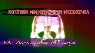 Признаки ВНУТРИЧЕРЕПНОГО ДАВЛЕНИЯ и ЭКТОПИЯ миндалин мозжечка на РАСШИФРОВКЕ МРТ головного мозга