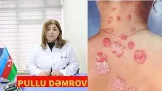 Psoriaz xəstəliyi (Pullu dəmrov) haqqında