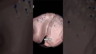 Revolutionizing Brain Surgery: The Power of Flexible Electrodes!