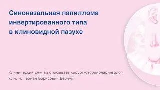 Синоназальная папиллома инвертированного типа в клиновидной пазухе