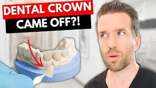 What should I do if my Dental Crown Falls Off?!