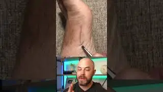 Doctor reacts to MASSIVE hair splinter! 