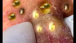 pimple popping - blackhead removal - blackheads removal - acne treatment - skin care | P002