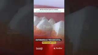 IMPRESIONANTE animación sobre la PERIODONTITIS - Efectos en el cuerpo y TRATAMIENTO